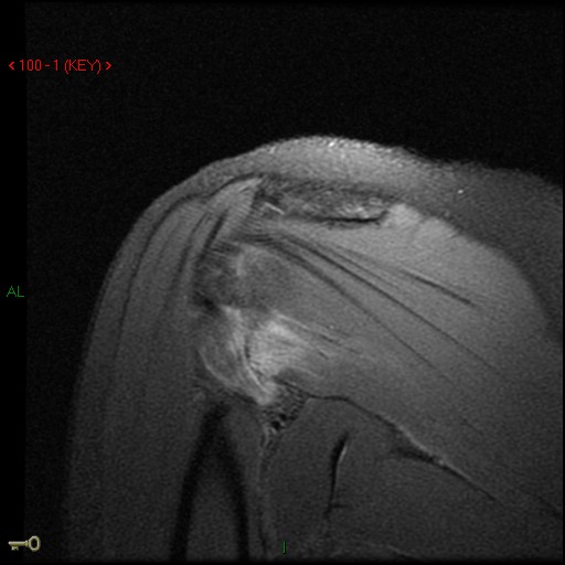 Figure 4 for case Posterior dislocation, posterior capsular avulsion from humerus   teres minor tear